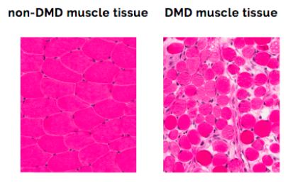 Graphic representation of dystrophin inside the muscle cell membrane, and the dystrophin string running in between proteins